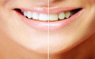 5 Tips for An Effective Tooth Whitening Treatment