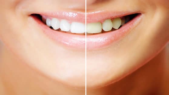 Before & After Tooth Whitening