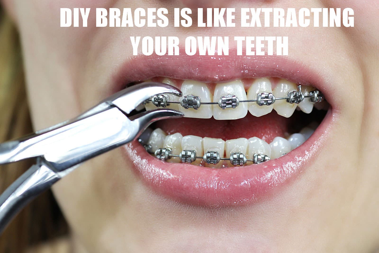 braces things dentist without fix diy underbite center orthodontic critical dmd adjustment yourself