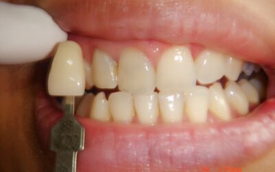 Tooth VS Restorative Material