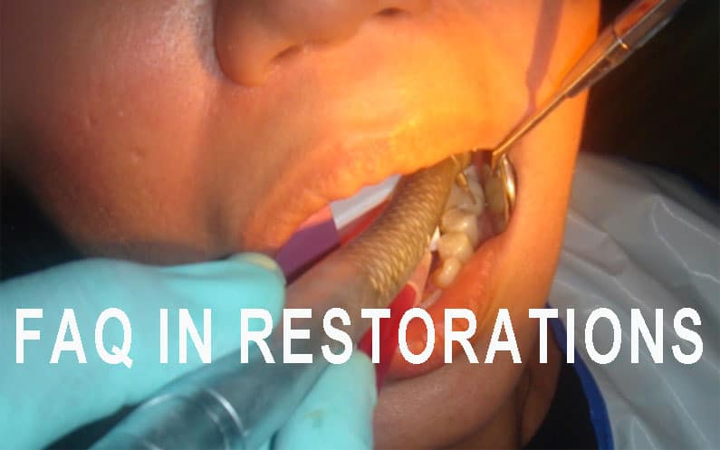 FAQ in Dental Restorations