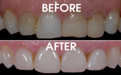 Part 2: 5 Factors For A Successful Veneer Treatment