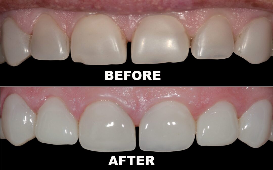 Part 1: Intro – An In-Depth Guide On Veneers