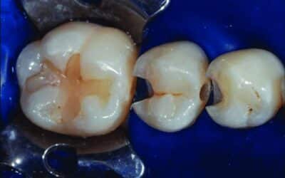 Dental Significance of Chlorhexidine