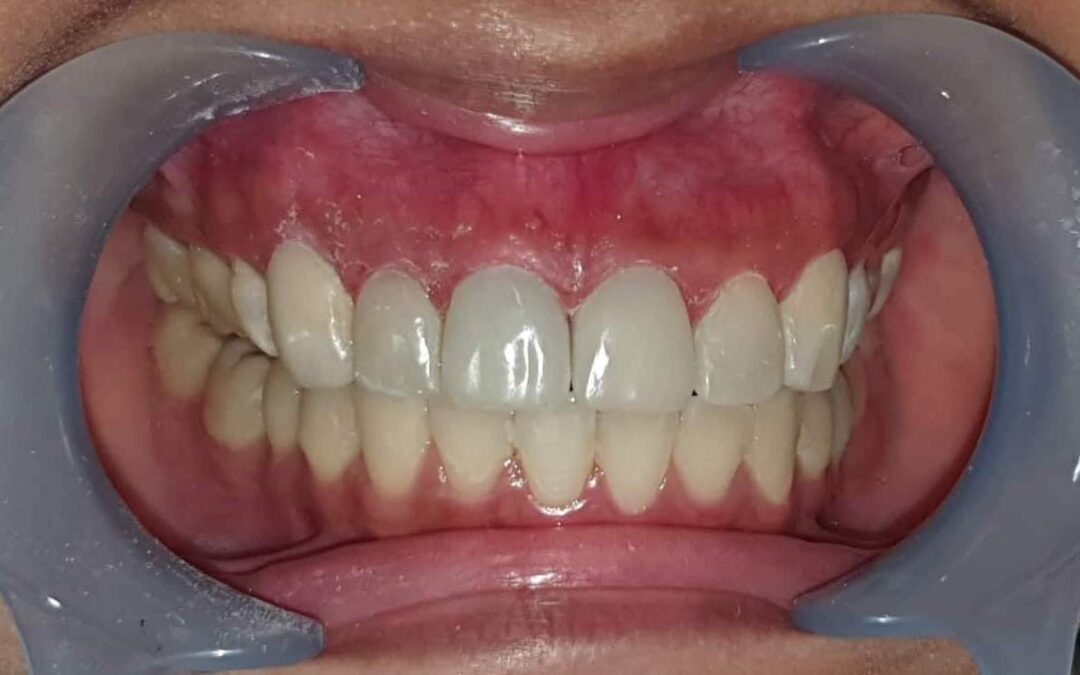 Part 3: 5 Common Mistakes in Veneer Treatment & How to Prevent It