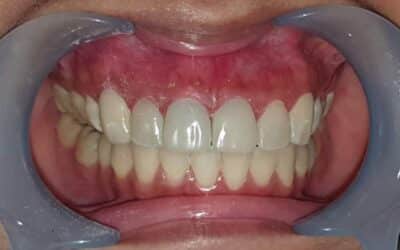 Part 3: 5 Common Mistakes in Veneer Treatment & How to Prevent It