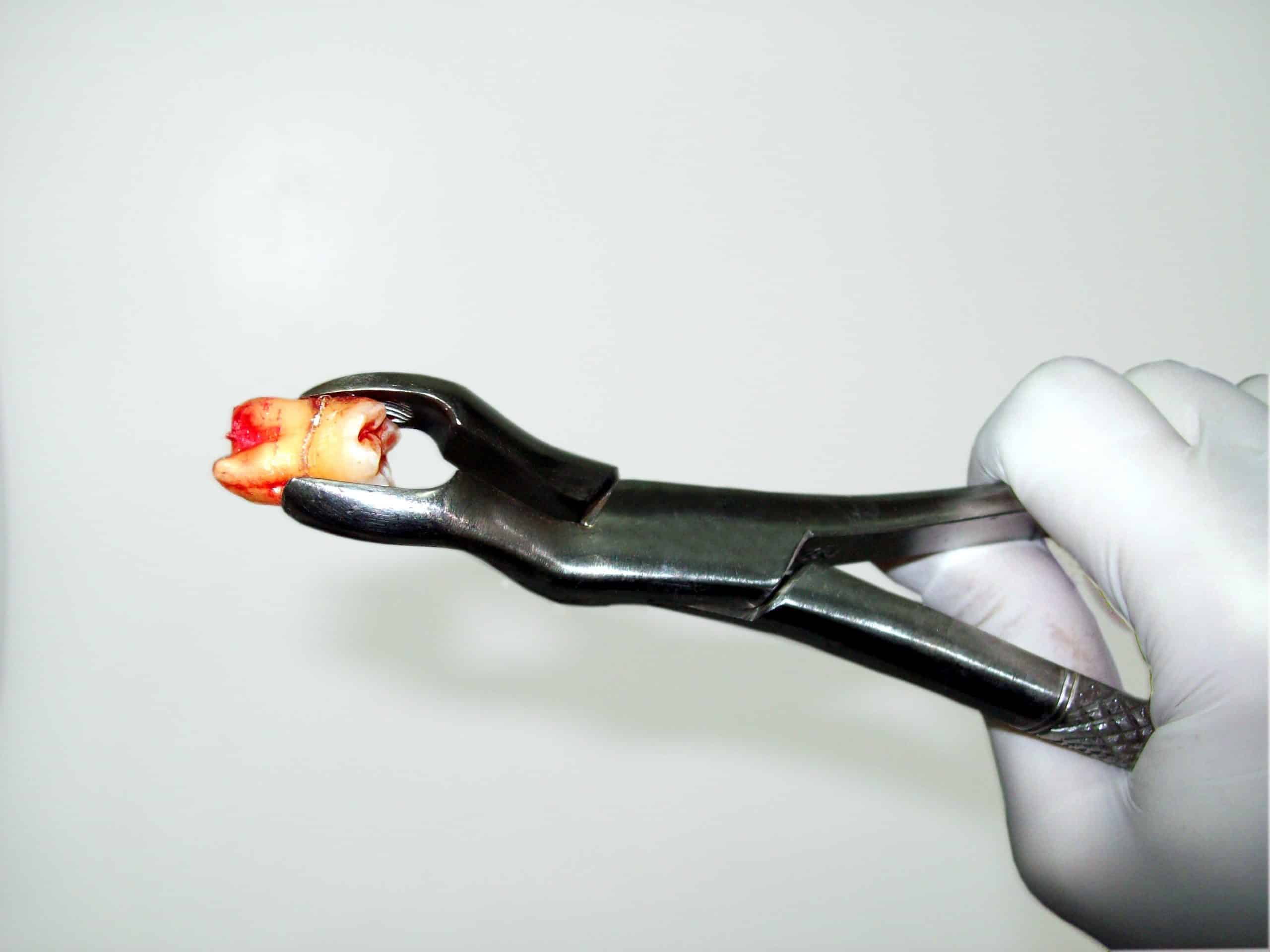 Extracted Tooth with Blood