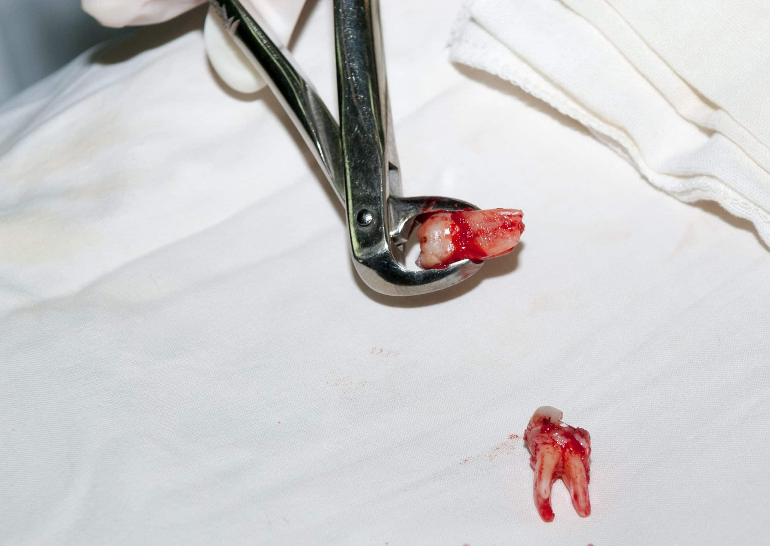 Extracted Teeth