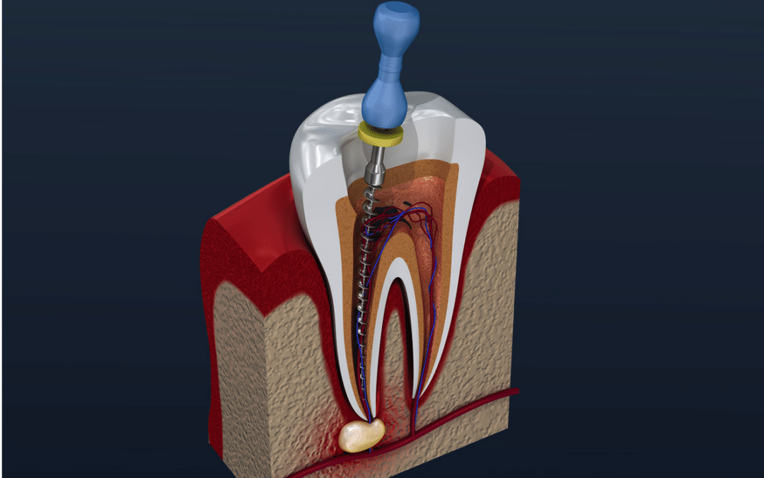 Achieve Efficiency By Understanding RCT Tools Part 1