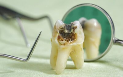 Your Options For Effectively Addressing Non-Vital Tooth