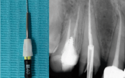 Removal of a Separated Endodontic Instrument: A Case Report