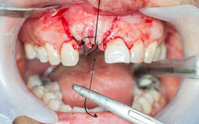 Suturing for Oral Surgical Success