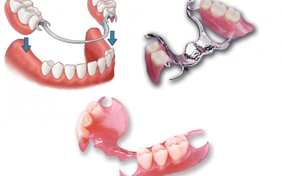 Removable Partial Denture: Review On Its Classification