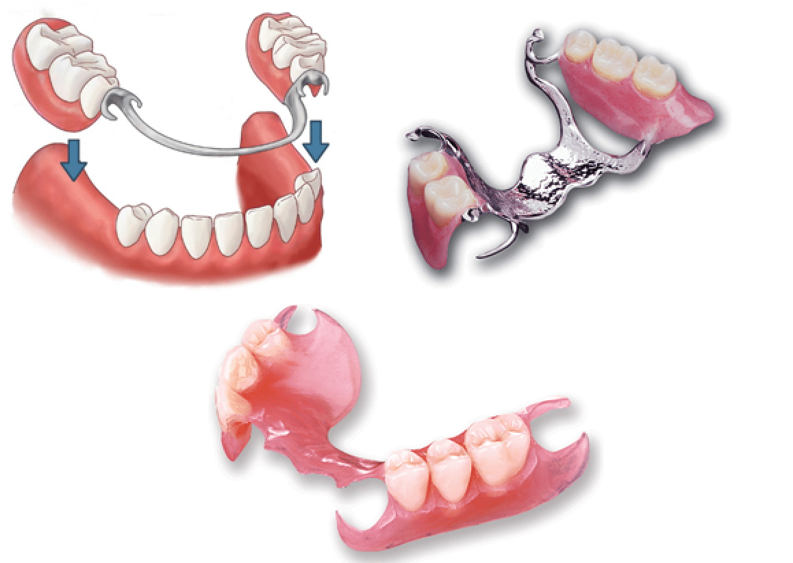 Removable Partial Denture Classification