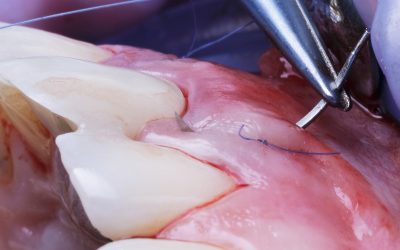 Guide to Suturing Materials for Surgical Success