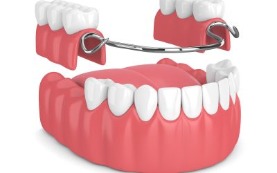 Retentive Parts of Removable Partial Dentures