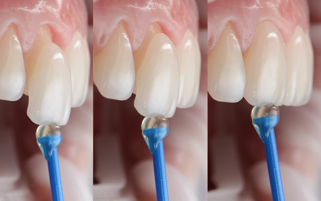 Your 5 “Less Is More” Dental Treatment Options