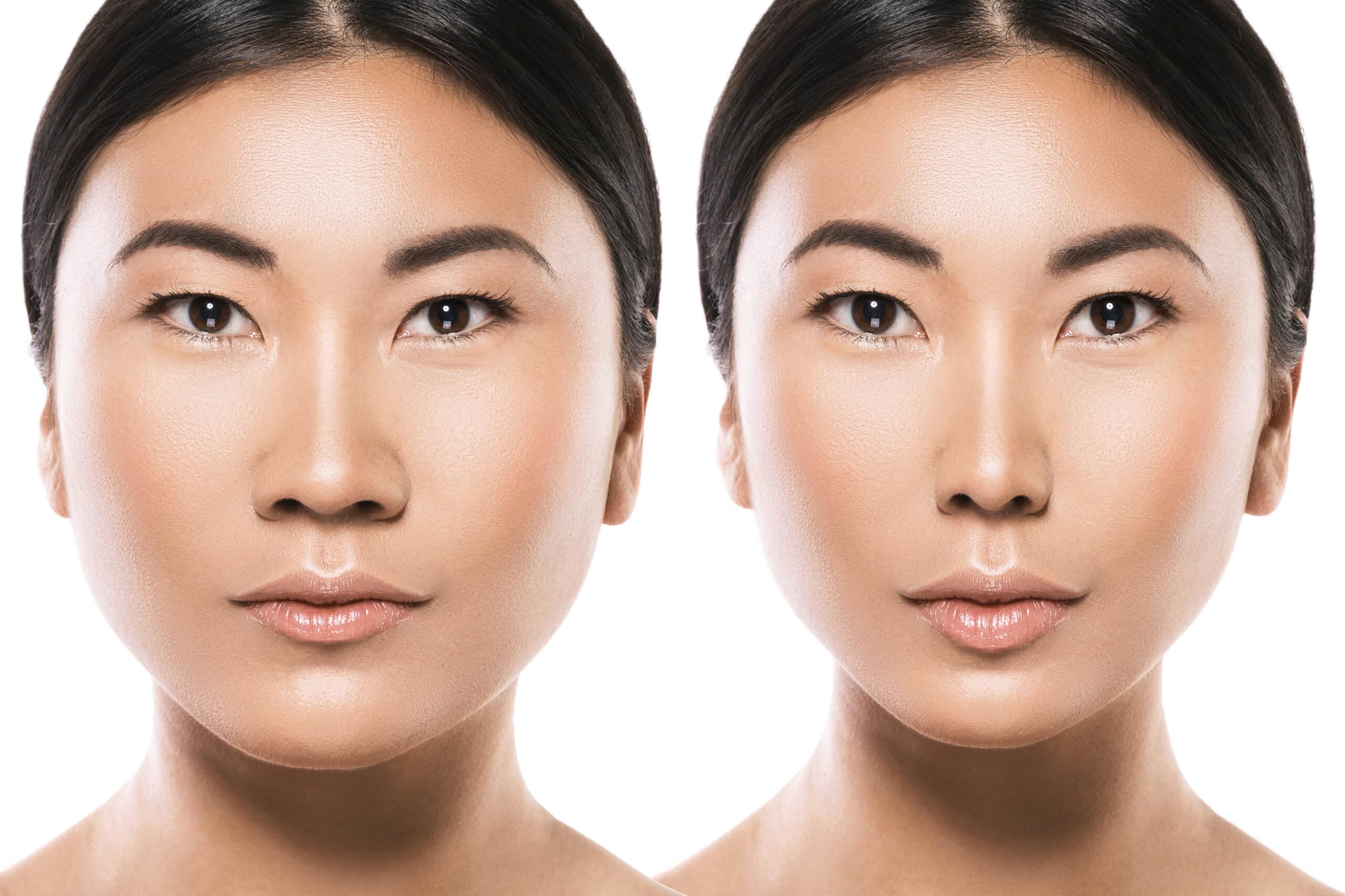 Before and After Derma Fillers