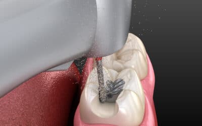 Bevels In Dentistry For Durable Restoration