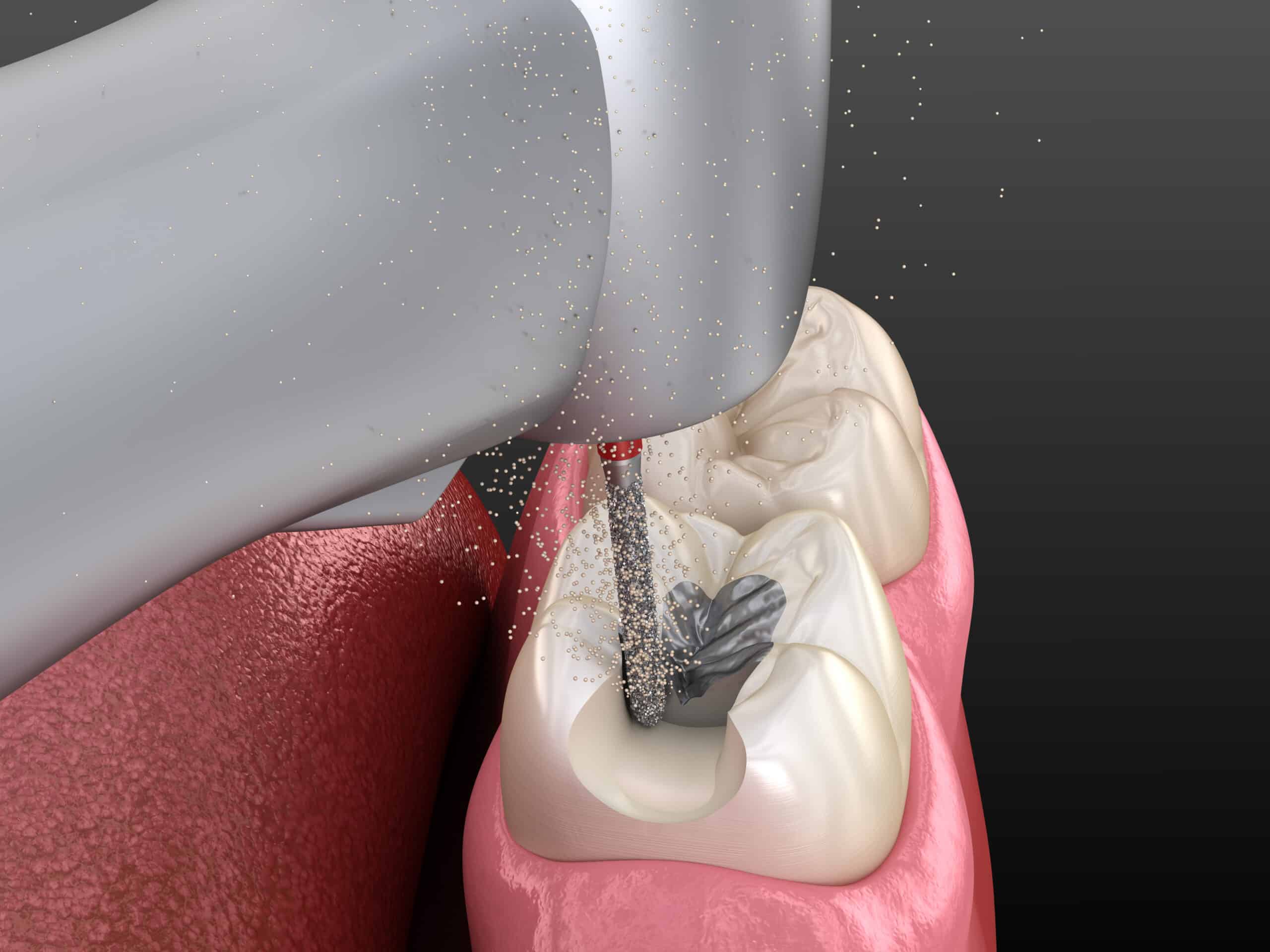 Bevel in Tooth Preparation